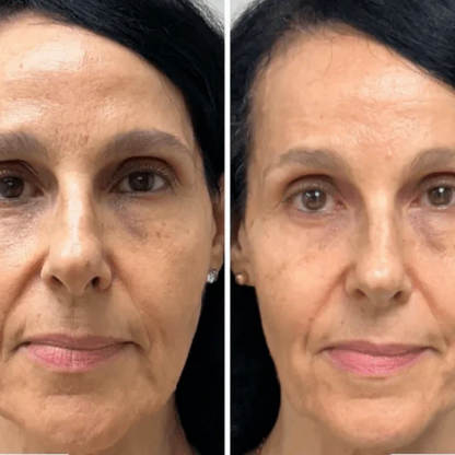 Korėjietiška jauninamasis kolageno kaukė – Collagen Fit™